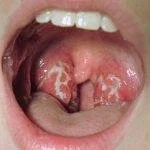 болезнь ЛОР рот
